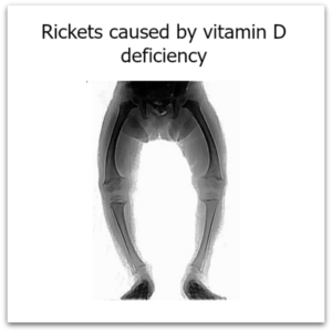 rickets, vitamin D deficiency